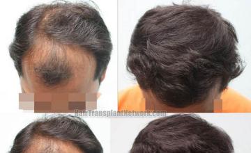 Hair transplantation surgery before and after photos