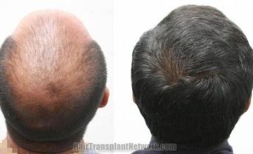 Back view before and after hair transplantation photos