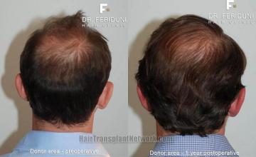 Hair transplantation surgery before and after images