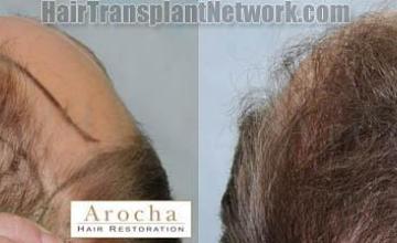 Hair transplantation surgery before and after pictures