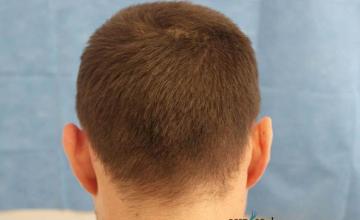 Hair transplantation surgery before and after pictures