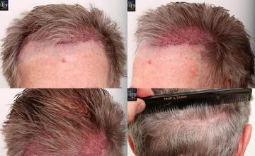 Hair transplantation surgery before and after pictures