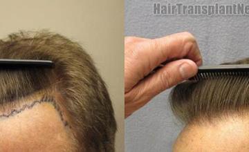 Hair transplantation surgery before and after images