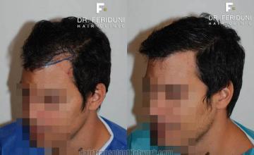 Hair transplantation surgery before and after pictures