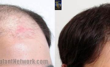 Hair transplantation surgery before and after images