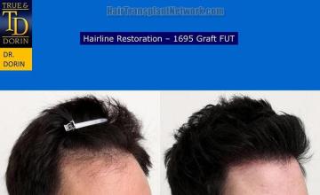 Hair transplantation surgery before and after images