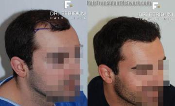 Hair transplantation surgery before and after pictures