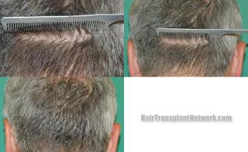 Hair transplantation surgery before and after images