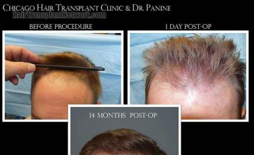 Hair restoration procedure before and after results