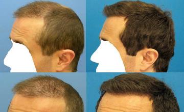 Left side before and postoperative hair transplant images