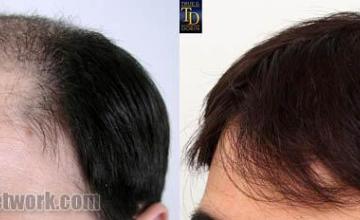 Hair transplantation surgery before and after pictures