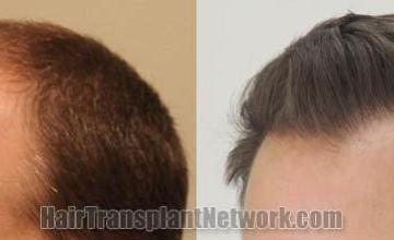 Hair restoration procedure before and after pictures