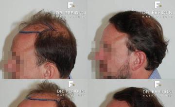 Hair transplantation surgery before and after photos