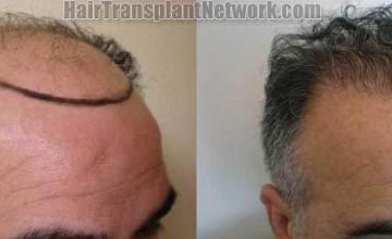 Hair transplantation surgery before and after images