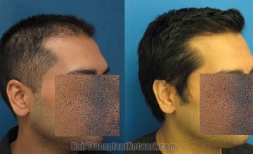 Hair restoration procedure before and after results