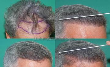 Hair restoration procedure before and after results