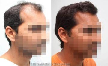 Hair transplantation surgery before and after images