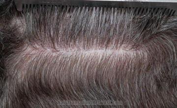 Residual scar from hair transplant patient donor area