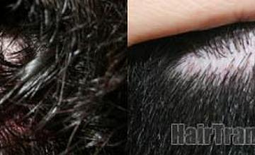 Hair transplantation surgery before and after pictures