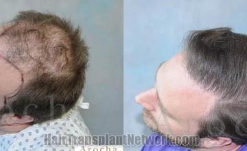 Hair transplantation surgery before and after photos