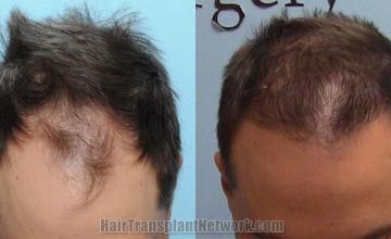 Hair transplantation surgery before and after photos