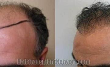 Hair transplantation surgery before and after images