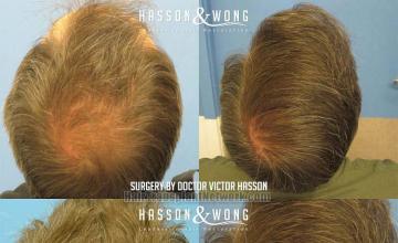 Hair replacement surgery before and after images