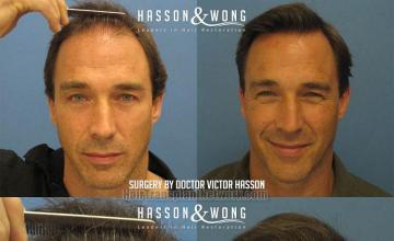 Hair transplant surgery before and after pictures