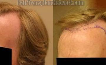 Before and after surgical hair restoration images