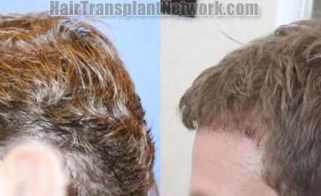 Hair transplantation surgery before and after images