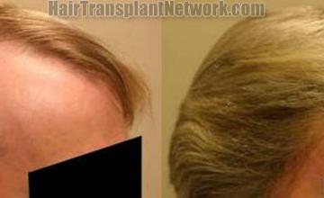 Right view before and after hair restoration results