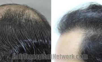 Hair transplantation surgery before and after pictures