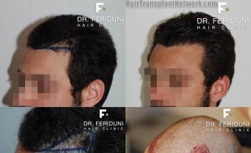 Hair transplantation surgery before and after pictures