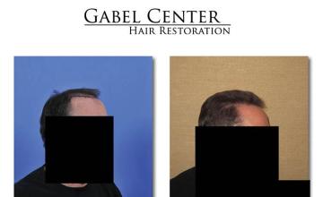 Hair transplantation surgery before and after images