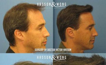 Hair restoration procedure before and after result images