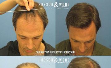 Before and after hair transplant procedure images