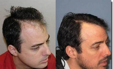 Hair restoration procedure results