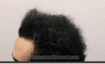 Hair restoration procedure results