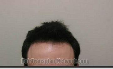 Hair restoration procedure results