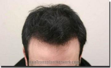 Hair restoration procedure results