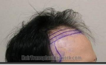 Hair restoration procedure results