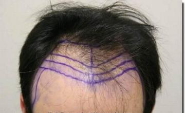 Hair restoration procedure results