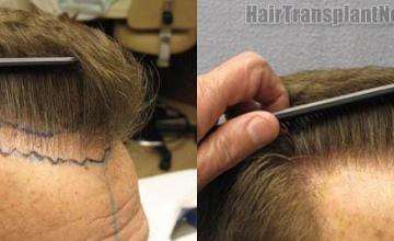 Hair transplantation surgery before and after photos
