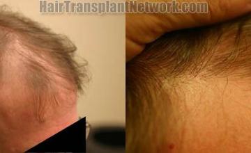 Hair transplantation surgery before and after images