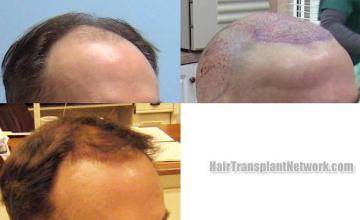  before and after photos