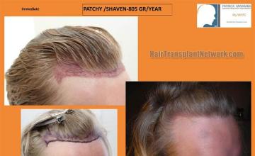 Hair transplantation surgery before and after photos