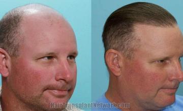 Hair transplantation surgery before and after images