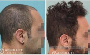 Hair transplantation surgery before and after images