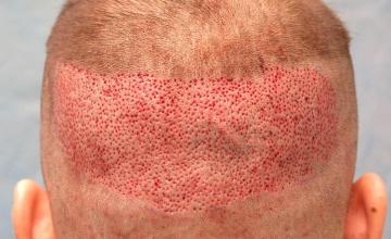 Hair transplantation surgery before and after photos 