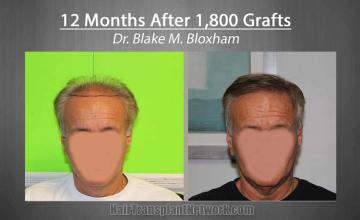 Hair restoration procedure before and after pictures